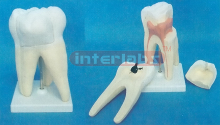 WEST-STYLE CARIES MOLAR MODEL WITH SQUARE PLASTIC BASE (3 PCS / SET)